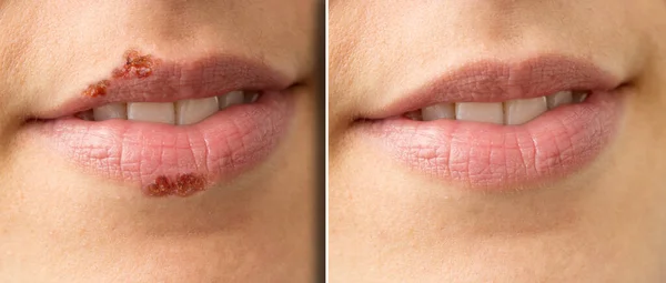 Primeros Planos Los Labios Una Mujer Antes Después Del Tratamiento — Foto de Stock