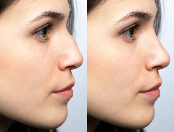 Closeup of a young woman\'s nose before and after nasal filler surgery. Rhinoplasty without surgery but with temporary injections of hyaluronic acid based fillers.