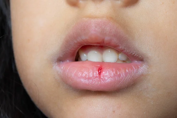 Close Pale Female Girl Lips Cracked Frost Wind Lack Vitamins — Fotografie, imagine de stoc