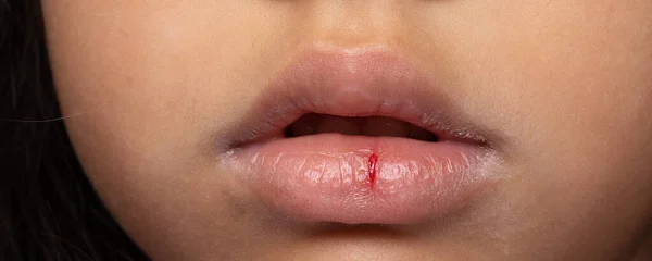 Nahaufnahme Junges Mädchen Trockene Lippen Mit Riss Und Sichtbarem Blut — Stockfoto