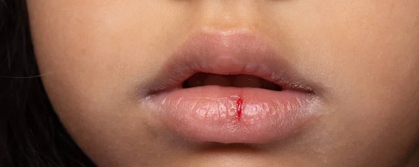 Close Jovem Menina Lábios Secos Com Crack Condição Médica Sangue — Fotografia de Stock