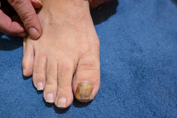 Closeup View Foot Man Yellow Thick Big Toenail Symptoms Onychomycosis — Stock Photo, Image