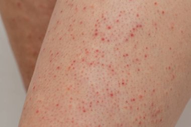 Legskin macro of a young woman suffering from pillar keratosis, frequent cause of atopic dermatitis and sketchy