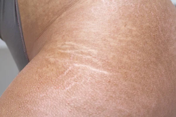 Closeup of a woman\'s thigh with stretch marks and skin spots. Concept of signs due to loss and regain weight and dermatological disorders