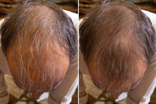 top view, before and after baldness treatment. Details of the hair of a man suffering from thinning and thinning of the scalp