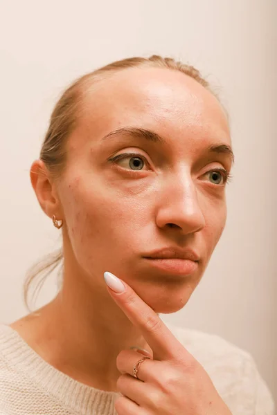 Teenage girl points a finger at her cheek with acne — Stock Photo, Image