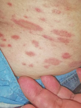 PR Pityriasis rosea bir cilt hastalığıdır. Buna bir virüsün sebep olabileceği düşünülüyor. Bu kanıtlanamaz.