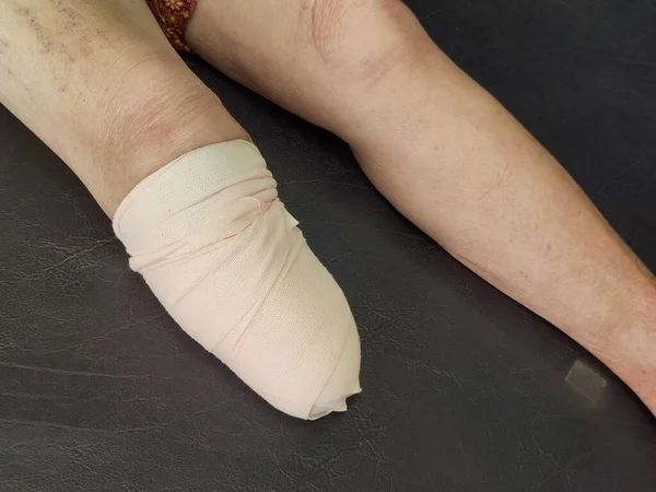Below knee amputation bandaging for BK prosthesis.