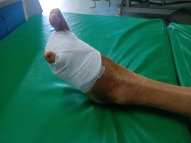 Picture of a diabetic foot infection