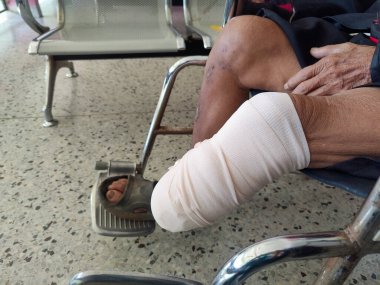 below knee amputation Patient with elastic bandaging to prepare for leg prosthesis