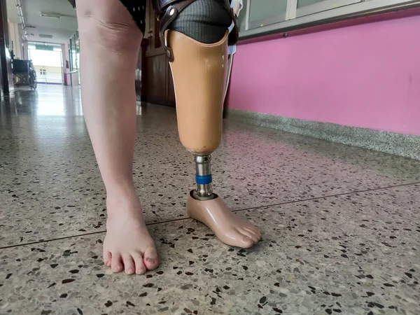 Funktionshindrade Unga Kvinnor Försöker Med Proteser — Stockfoto