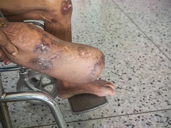 diabetes foot infection, DM patient have wound at arch of foot and chronic infection