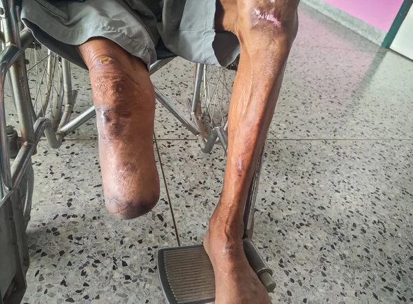 diabetes foot infection, DM patient have wound at arch of foot and chronic infection