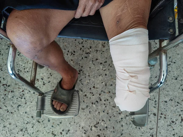 below knee amputation Patient with elastic bandaging to prepare for leg prosthesis