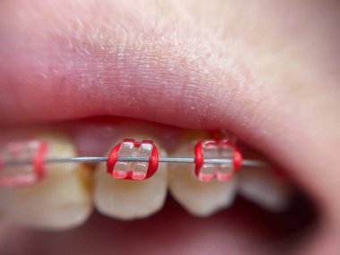 Diş telleri süper makro, çarpık dişler, kırık safir teller.