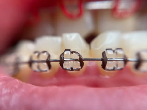 Dental braces super macro , crooked teeth, broken sapphire braces