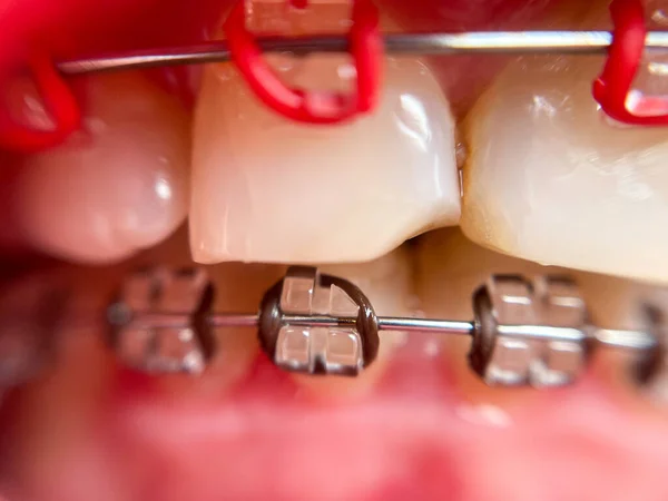 Diş telleri süper makro, çarpık dişler, kırık safir teller.