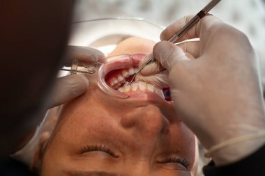 Bir ortodonti uzmanının, Latin bir kadının üzerine görünmez diziliciler yerleştirmesi ve ayarlaması. Görünmez ortodonti tekniği kavramı.