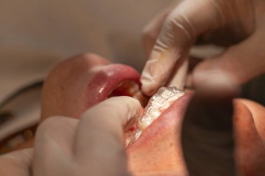 Bir ortodonti uzmanının, Latin bir kadının üzerine görünmez diziliciler yerleştirmesi ve ayarlaması. Görünmez ortodonti tekniği kavramı.