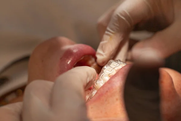 Bir ortodonti uzmanının, Latin bir kadının üzerine görünmez diziliciler yerleştirmesi ve ayarlaması. Görünmez ortodonti tekniği kavramı.