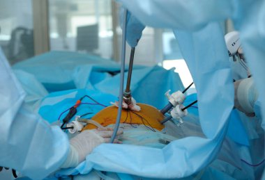 Laparoskopi ameliyatı. Cerrahın eli hastanın karnına laparoskopik bir alet takmış..