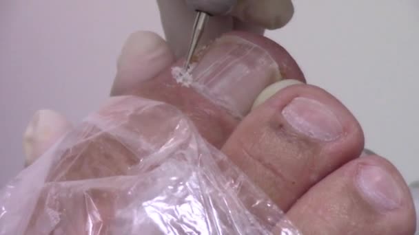 Podiatry Treatment Feet Nails — Stock Video