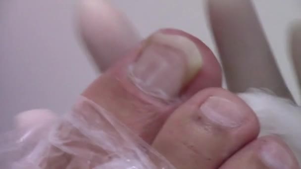 Podiatry Treatment Feet Nails — Stock Video