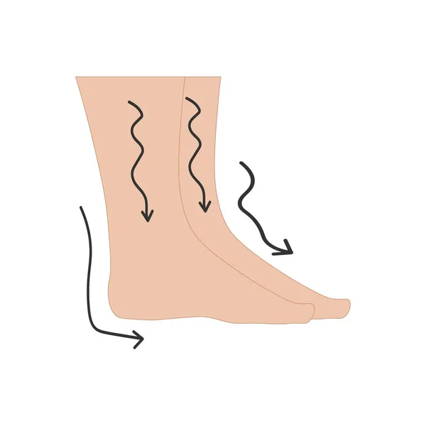 人間の足と足の腫れ — ストックベクタ