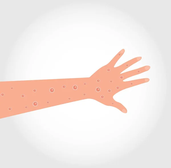 Monkeypox Virus Wounds Hand Arm Vectorial — Stock Vector
