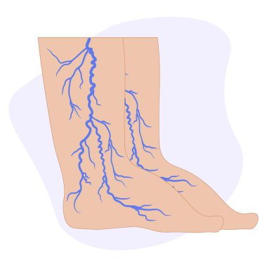 Venöz yetersizlik tıbbi vektör çizimi