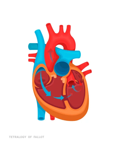 心脏缺陷 猎鹰的四分法 医药书籍 应用程序的说明 有名字的心脏病 — 图库矢量图片