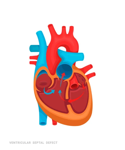 心脏缺陷 心室间隔缺损 医药书籍 应用程序的说明 有名字的心脏病 — 图库矢量图片
