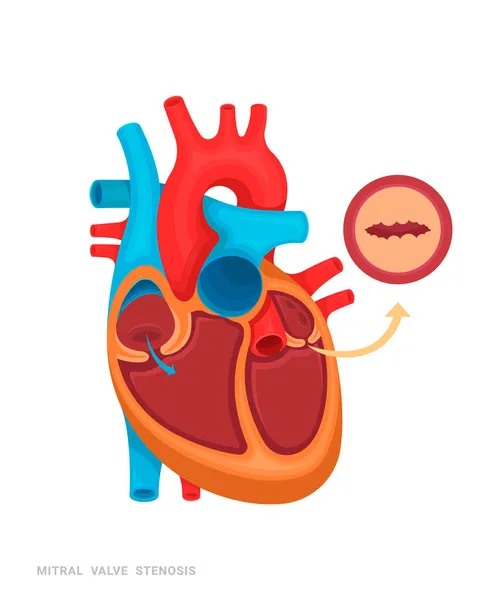 心脏缺陷 二尖瓣狭窄 医药书籍 应用程序的说明 有名字的心脏病 — 图库矢量图片