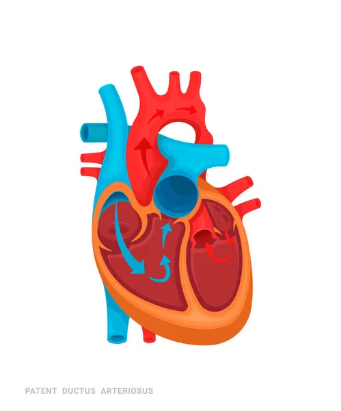 Hjärtfel Patent Ductus Arteriosus Illustration För Medicinböcker Webbplatser Appar Hjärtsjukdom — Stock vektor