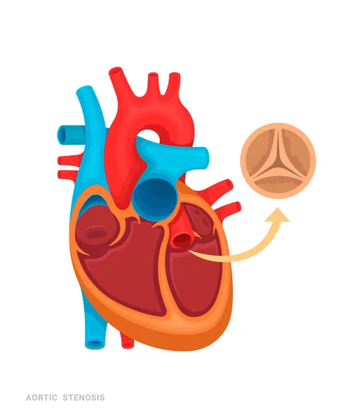 心脏缺陷 主动脉狭窄 医药书籍 应用程序的说明 有名字的心脏病 — 图库矢量图片