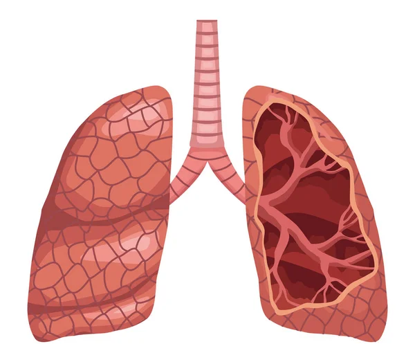Mezzo organo polmonare — Vettoriale Stock