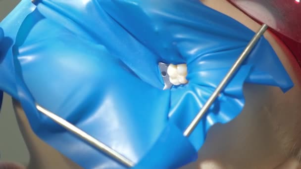 치아 충전재, 구강 관리를 준비하는 치과 의사의 모습을 클로즈업 한 모습 — 비디오