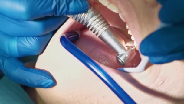 Запись сверления зубов стоматологом и подготовка к заполнению зубов — стоковое видео