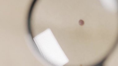 Close up video of doctor investigate mole on patient with magnifying glass.