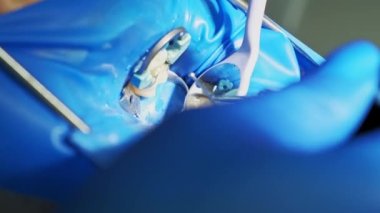 Close up footage of dentist working tooth filling in clinic.