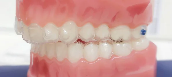 Tratamento Invisalign Anestesia Dentária — Fotografia de Stock