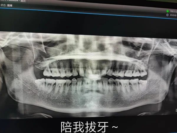 x-ray image of human teeth with medical braces and patient in clinic.