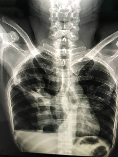 Крупным Планом Рентгеновской Пленки Легких — стоковое фото