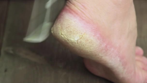 Una mano con una lima metálica limpia la piel agrietada en el talón del pie. — Vídeo de stock