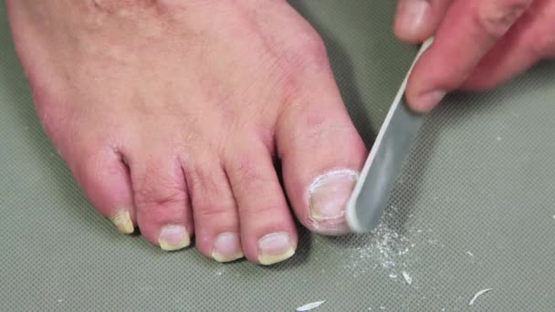 Une main d'homme avec une lime en plastique grise broie un gros ongle sur son pied. — Video