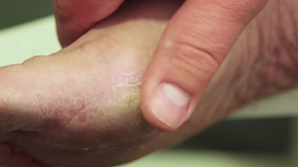 Ręka masuje ludzką stopę kalusiem.. — Wideo stockowe
