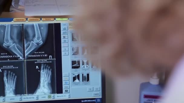X-rays of the foot and knee on a computer screen — Stock Video