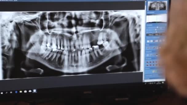 The doctor looks at x-rays of teeth on the screen — Stock Video