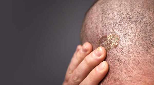 Человек с сухой чешуйчатой кожей на голове с псориазом и грибком на руках. Аутоиммунные генетические заболевания.