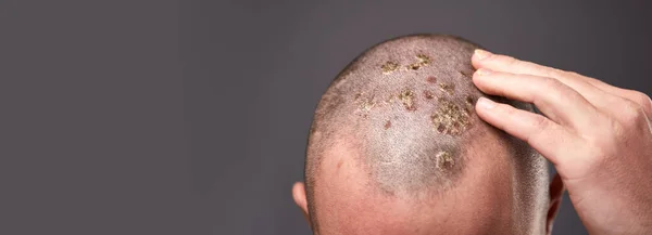 Homem Com Pele Seca Escamosa Cabeça Com Psoríase Fungos Nas — Fotografia de Stock